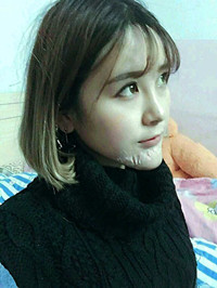 自體脂肪墊下巴前后手術(shù)過(guò)程以及對(duì)比恢復(fù)照片分享