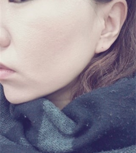 電波l皮緊膚除皺，的確是年輕了不少