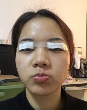 為了美麗大眼做了切開(kāi)雙眼皮，果令我驚嘆