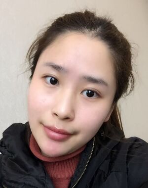 深圳美萊整形醫(yī)院做了進(jìn)口硅膠墊下巴臉型都變好看了