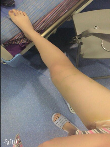 馮斌幫我做的大腿吸脂 果真的很棒