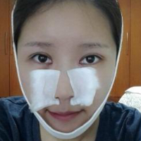 做了埋線雙眼皮、隆鼻、磨下頜角，兩個(gè)月了，分享恢復(fù)照片~