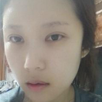 做了埋線雙眼皮、隆鼻、磨下頜角，兩個(gè)月了，分享恢復(fù)照片~