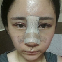 埋線雙眼皮+隆鼻手術(shù)恢復(fù)過程和前后對比果圖片真實(shí)分享~~~