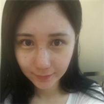 埋線雙眼皮+隆鼻手術(shù)恢復(fù)過程和前后對比果圖片真實(shí)分享~~~