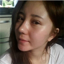 埋線雙眼皮+隆鼻手術(shù)恢復(fù)過程和前后對比果圖片真實(shí)分享~~~