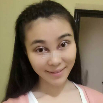 開外眼角手術(shù)一個(gè)月了，分享恢復(fù)過程和前后對(duì)比果照片~