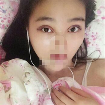 開外眼角手術(shù)一個(gè)月了，分享恢復(fù)過程和前后對(duì)比果照片~