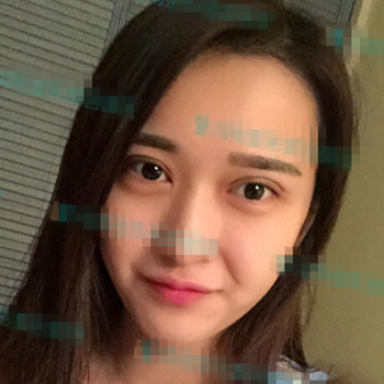 伊美馨做了開內(nèi)眼角和雙眼皮手術(shù)，分享我的術(shù)后果照片~~