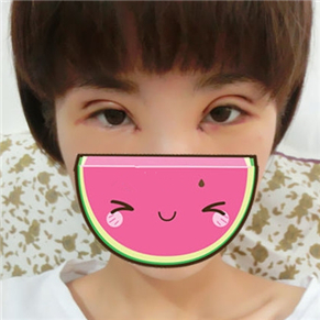 雙眼皮失敗修復(fù)手術(shù)前后對比果圖片分享，伊美馨做的哦·