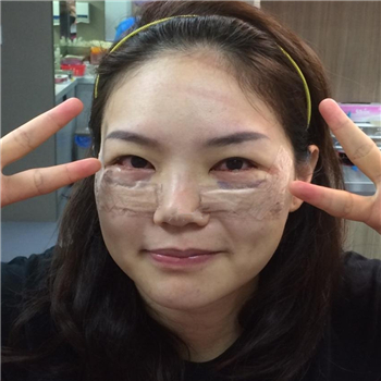 李阿姨眼袋失敗修復(fù)手術(shù)后的果圖，年輕了好幾歲~