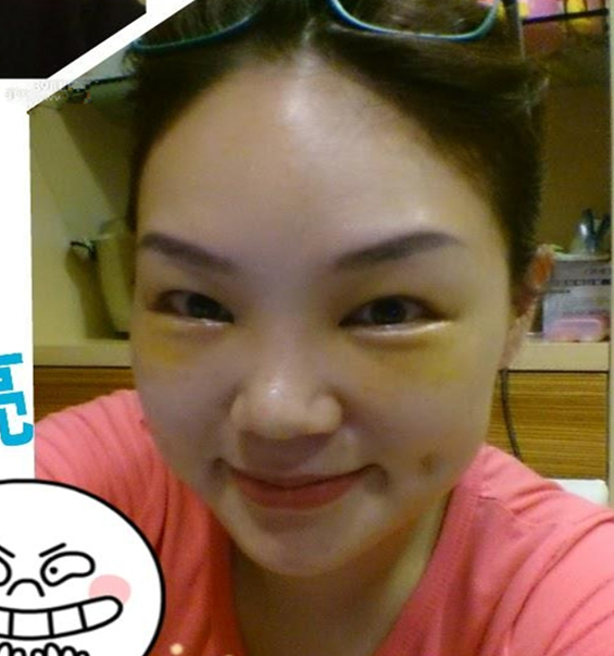 李阿姨眼袋失敗修復(fù)手術(shù)后的果圖，年輕了好幾歲~