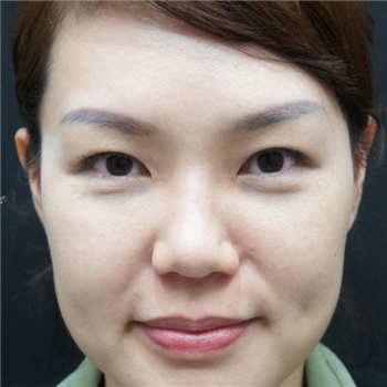 李阿姨眼袋失敗修復(fù)手術(shù)后的果圖，年輕了好幾歲~