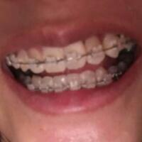 牙齒正畸矯正一年費用10000元