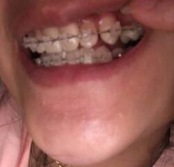 牙齒正畸矯正