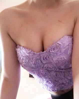 自體脂肪豐胸對比圖 抽脂隆胸十天