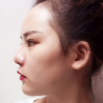 假體墊下巴一個月 前后對比