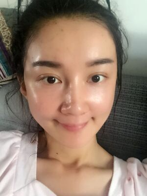 干癟的臉在自體脂肪面部填充后巨飽滿