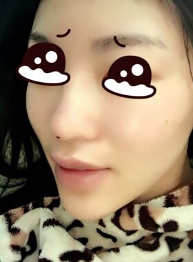 線D隆鼻恢復過程圖，看看我的果怎么樣