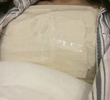 來看看我做的花樣年華假體隆胸果怎么樣