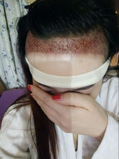 植發(fā)拯救了我的高發(fā)際線 果很棒哦**