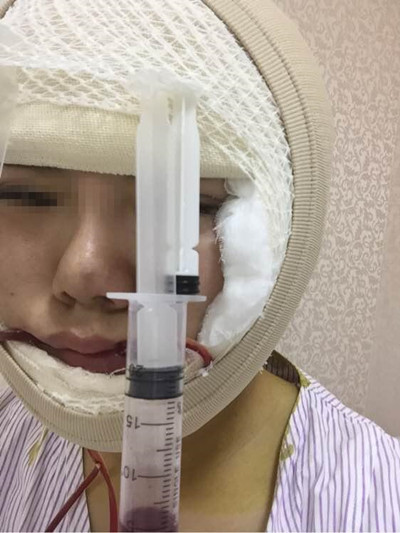 磨骨手術讓我變成小v臉 果真的很不錯