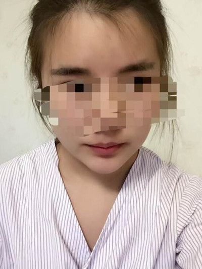 磨骨手術讓我變成小v臉 果真的很不錯