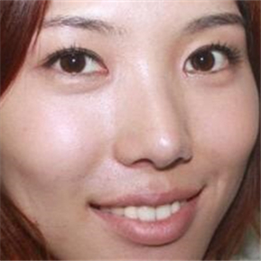 武漢希思特做了埋線法雙眼皮、開內(nèi)眼角和鼻尖移植軟骨整形手術(shù)~