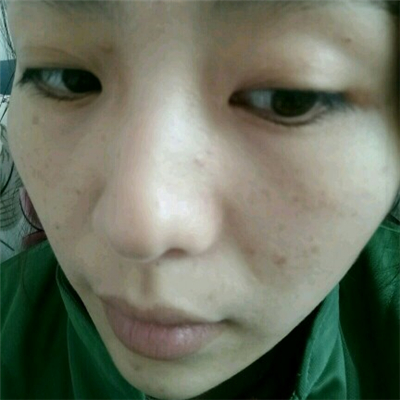 光子嫩膚和下巴脂肪填充術(shù)后果圖片分享，董萍門(mén)診做的~