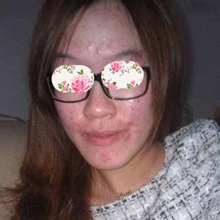 激光祛痘手術(shù)恢復(fù)過(guò)程分享，還有前后對(duì)比果圖片哦~