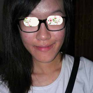 激光祛痘手術(shù)恢復(fù)過(guò)程分享，還有前后對(duì)比果圖片哦~