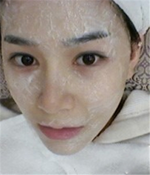 元旦做的光子嫩膚，分享恢復(fù)過(guò)程和前后對(duì)比果照片哦~