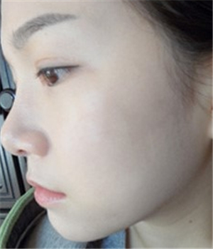 元旦做的光子嫩膚，分享恢復(fù)過(guò)程和前后對(duì)比果照片哦~