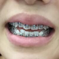 上海牙齒矯正過程分享，牙齒正畸8900元