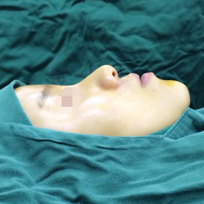 歪鼻矯正手術(shù)前后過程以及恢復(fù)照片對(duì)比照