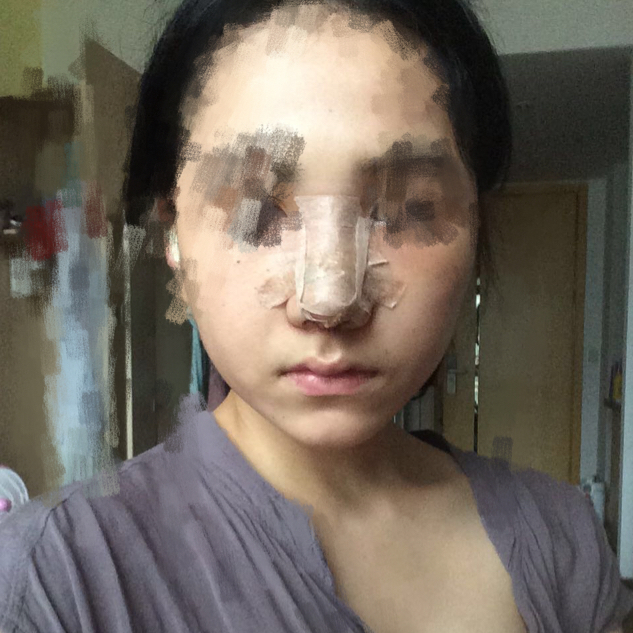 歪鼻矯正手術(shù)前后過程以及恢復(fù)照片對(duì)比照