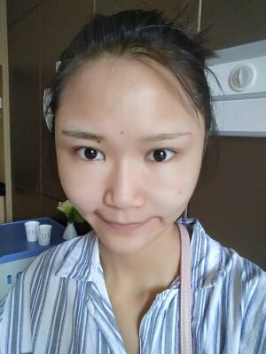 自體脂肪面部填充后恢復(fù)，成活率還蠻高的