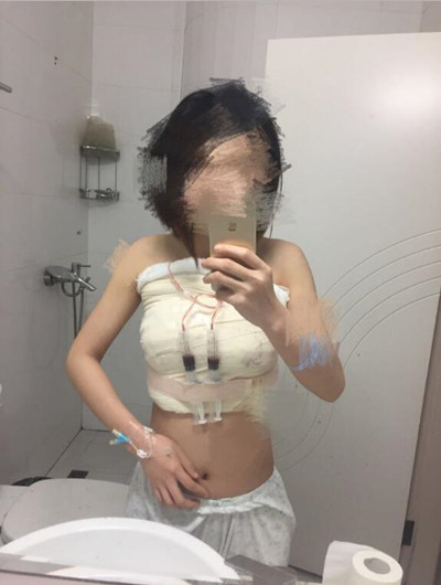 假體隆胸拯救了我的小平胸 快來看看我的果怎么樣