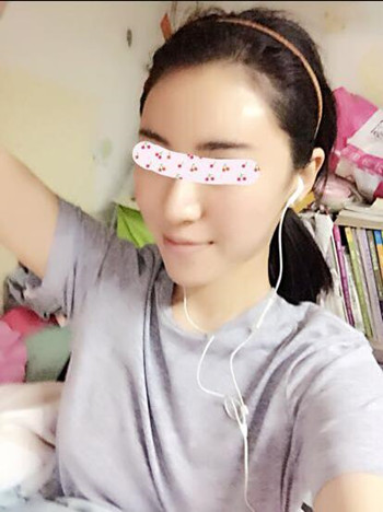 給大家分享一下我的自體脂肪填充全臉經(jīng)歷 內(nèi)有果對比圖