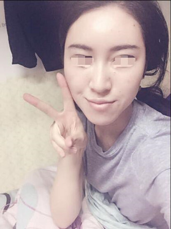 給大家分享一下我的自體脂肪填充全臉經(jīng)歷 內(nèi)有果對比圖