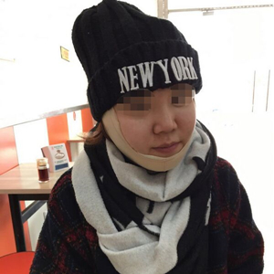 吸脂瘦臉手術半年了，分享前后對比果照片~