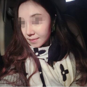 吸脂瘦臉手術半年了，分享前后對比果照片~