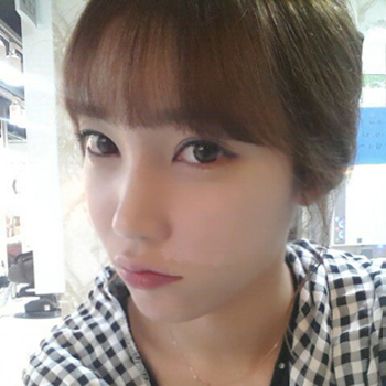 長沙美萊做了磨顴骨手術(shù)，分享恢復(fù)過程和前后對比果圖片~