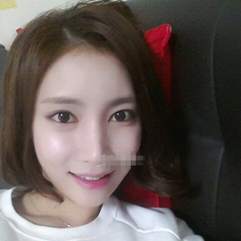 長沙美萊做了磨顴骨手術(shù)，分享恢復(fù)過程和前后對比果圖片~