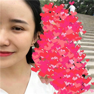 北京美萊做了雙眼皮手術，分享前后對比果圖片~