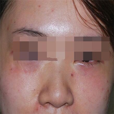 內(nèi)切去眼袋手術(shù)恢復(fù)過程和前后對比果圖片分享，美聯(lián)臣做的哦~