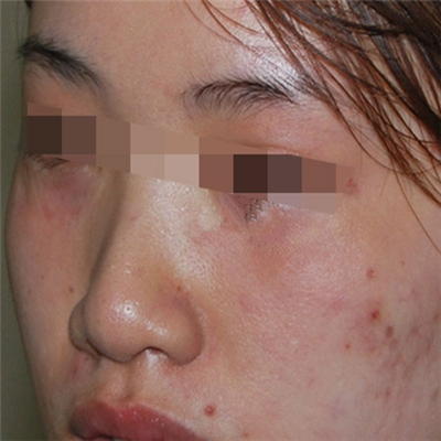 內(nèi)切去眼袋手術(shù)恢復(fù)過程和前后對比果圖片分享，美聯(lián)臣做的哦~