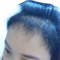 在雍禾植發(fā)醫(yī)院做微創(chuàng)微創(chuàng)植發(fā)經(jīng)歷分享，植發(fā)果很好