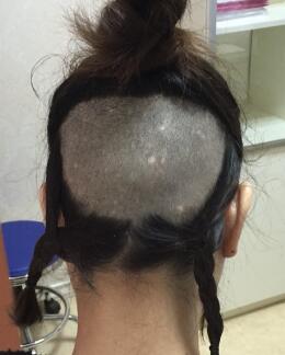 植發(fā)前提取后腦健康毛囊部位