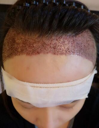 頭發(fā)種植經(jīng)歷分享